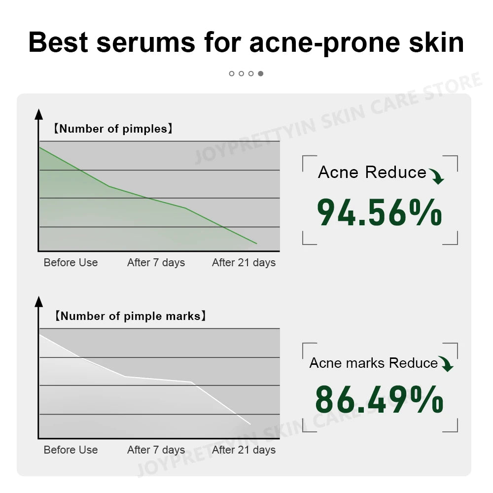 Tea Tree Acne Control Serum – Hydrating & Pore-Refining Essence